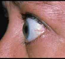 Ендокрина офталмопатија: третман, симптомите, дијагноза, класификација