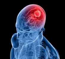 Епидурален хематом на мозокот: симптомите, третман, последиците