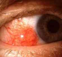 Еписклеритис око: третман, симптоми, причини