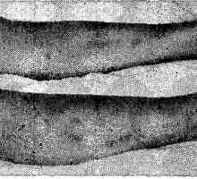 Erythema nodosum. клиничката слика