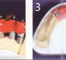 Чекори на производство на фиксна протеза долната вилица. Фази 6 април