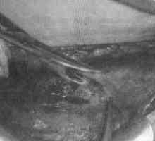 Царски рез попречно рез во долниот сегмент на матката