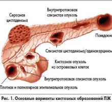Циста на панкреасот (глава и опашка), симптомите, предвидувањата за третман на тумори, фотографии
