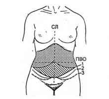 Класична abdominoplasty