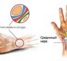 Компресија на улнарниот нерв на ниво на рачниот зглоб: Третман, Причини, Симптоми