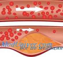 Кожен крвните садови во дијабетес мелитус. Микроангиопатија кај дијабетес