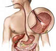 Лимфом на желудникот и дебелото црево: третман Pronoza, знаци, симптоми, причини