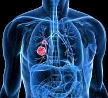 Мала ќелија рак на белите дробови: прогноза, третман, сцена, симптоми, знаци
