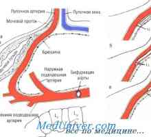 Методи на умбиликалната артерија катетеризација. Фитинг апарати умбиликална артерија катетер во