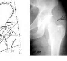 Методи на рентген дијагностика: Х-зраци на зглобот на колкот