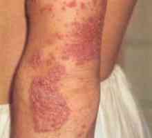 Miniatlas: заболувања на кожата придружени со чешање