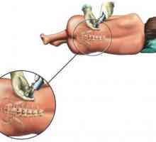 Анестезија и епидурална анестезија за време на операција за отстранување на хемороиди