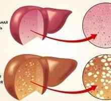 Безалкохолни масни заболување на црниот дроб: третман