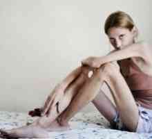 Анорексија нервоза: третман, симптоми, знаци, причини
