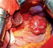 Тумори во стомакот