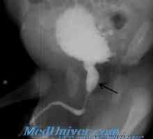 Опструкција на вратот на мочниот меур кај децата. вентили уретрата