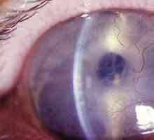 Офталмологија-користење контактни леќи во лекување на болести на рожницата