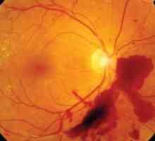 Оклузија на централната ретинална артерија: третман, причини, дијагноза