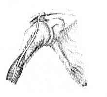 Операции на дисконтинуитети во тетивата на рамениот зглоб