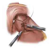 Хируршки третман на рефлукс езофагитис и fundoplication