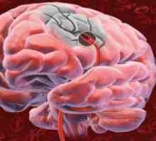 Тумор на мозокот и неговата мембрани, што доведе до пораз на визуелен пат