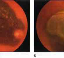 Тумори на ретината и хориоидеата: хороидална меланом