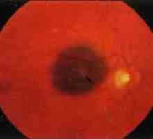 Тумори на ретината и хориоидеата: хороидална nevus