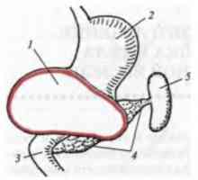 Карактеристики на хируршки третман на цисти на истмус и телото на панкреасот