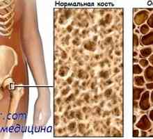 Остеомалација. Остеопороза и карактеризација на остеопороза