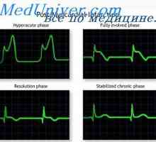 На акутната фаза на миокарден предниот ѕид. Миокарден инфаркт задниот ѕид на ЕКГ