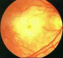 Акутна ретинална некроза: симптоми, третманот, причини, симптомите