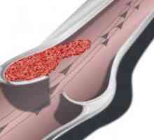 Акутна тромбоза на пониски артерии на екстремитетите