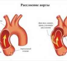 Аортна патологија во бременоста
