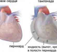 Перикардијален излив и срцева тампонада