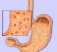 Првите знаци и симптоми на гастритис стомакот