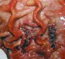 Сквамозниот клеточен рак на желудникот