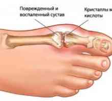 Гихт артритис на зглобовите: третман, симптоми, знаци, причини