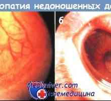 Класификација на ретинопатија кај предвремено родени деца
