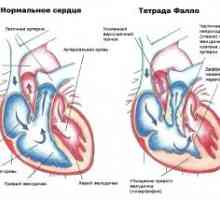 Срцева маана Тетралогија на Фало: третман, прогнозата знаци, симптоми, причини
