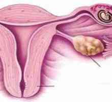 Губење на бременоста: инсуфициенција на грлото на матката