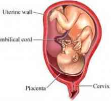 Предвремено одлепување на плацентата вообичаено се наоѓа, симптомите, причините, симптомите