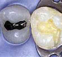 Директен естетска реставрација на задните заби со користење на напредни композитни материјали