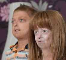 Progeria деца: симптоми, третманот, причини