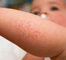 Pinworms манифестации на црвенило на кожата кога enterobioze