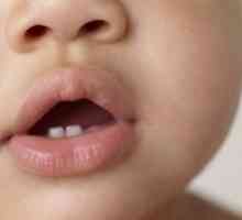 Почетнички кај доенчиња (бебиња, деца): симптоми, знаци