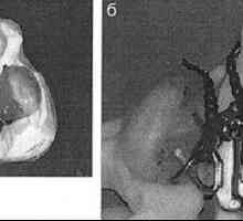 Почетокот на ортопедски третман на пациенти со билатерална расцеп на усна и непцето со употреба на…