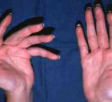 Ревматоиден артритис на зглоб: симптоми, третманот, причини, симптомите