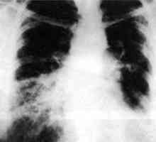 Резултатите од торакоскопска биопсија на белите дробови