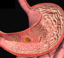 Gastritis симптоми и третман