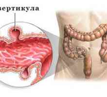 Симптоми и третман на дивертикулоза на дебелото црево сигмоиден